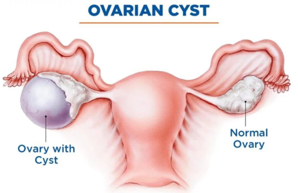 Understanding Laparoscopic Ovarian Cystectomy: A Minimally Invasive Solution for Ovarian Cysts