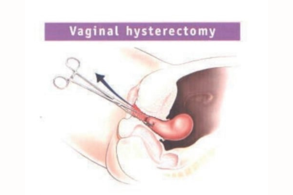 Vaginal Hysterectomy: Purpose, Procedure, and Benefits