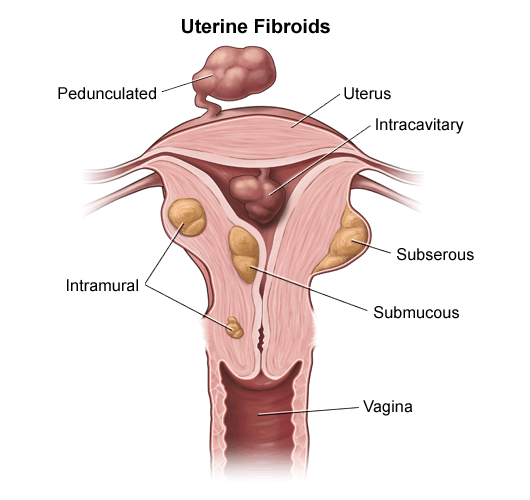 Understanding Myomectomy: An Ultimate Guide to Tackling Fibroids