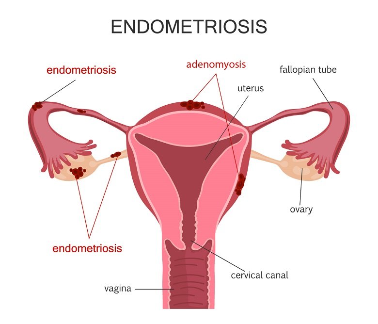 Endometriosis Surgery: Laparoscopy, Recovery, and More