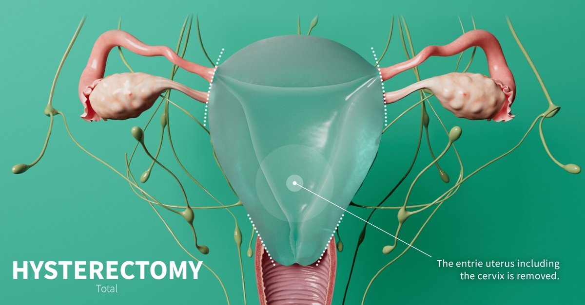 Hysterectomy Surgery in Noida : Dr. Neha Gupta