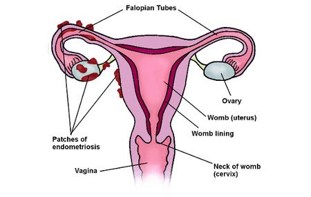 Robotic Surgery for Endometriosis: What It Is, Procedure, Recovery and Advantages