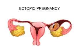 Laparoscopic Surgery for Ectopic Pregnancy