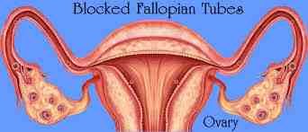 An Overview of Robotic Surgery for Fallopian Tube Blockage