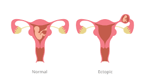 ectopic pregnancy treatment in Noida 
