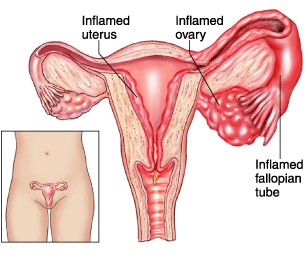 Pelvic Inflammatory Disease Treatment in Noida
