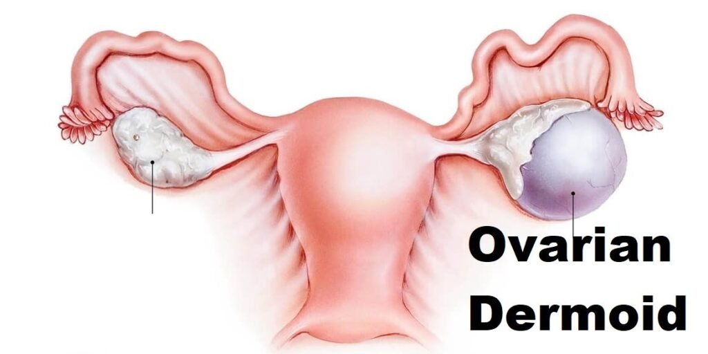 What Is A Dermoid Cyst? Symptoms, Diagnosis and Treatment What Is A Dermoid Cyst? Symptoms, Diagnosis and Treatment