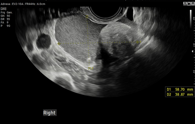 Dermoid Cyst Treatment In Noida