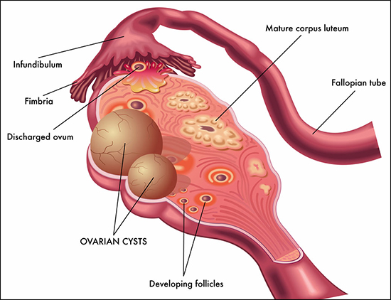 Paraovarian Cyst: Symptoms, Diagnosis & When to Consider Surgery