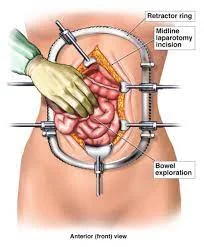 paraovarian cyst treatment in Noida 