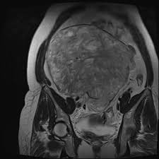 What Are Broad Ligament Fibroids? Symptoms, Causes and Treatment What Are Broad Ligament Fibroids? Symptoms, Causes and Treatment