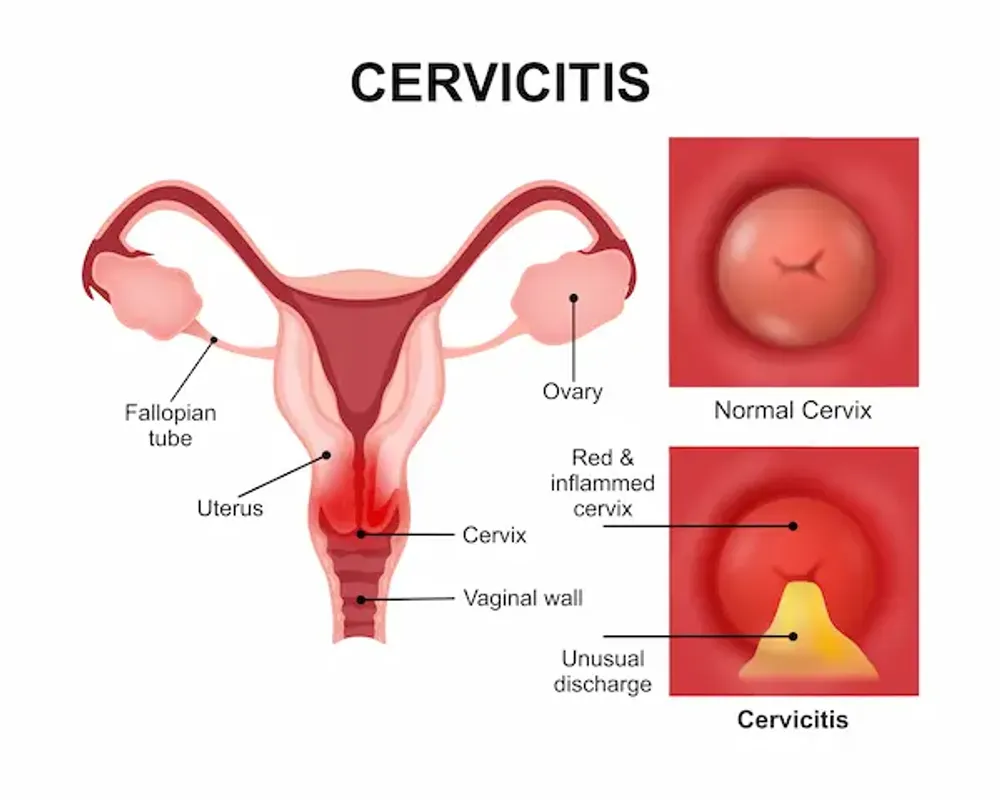 Cervicitis Treatment: Symptoms, Causes & When To See A Doctor