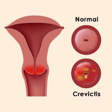 Cervicitis Treatment In Noida